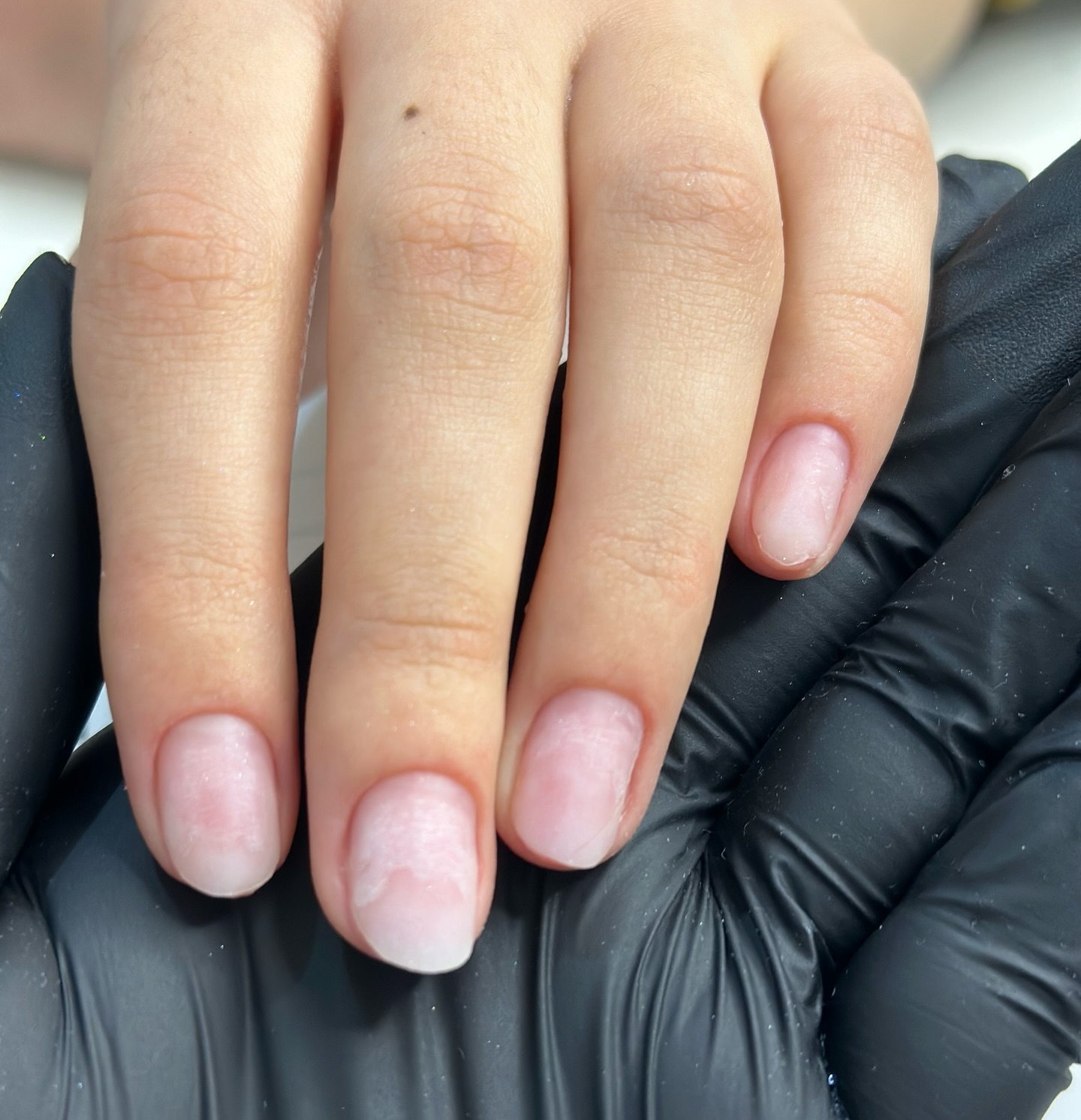 Bella Beauty Medikal Pedikür Öncesi Sonrası